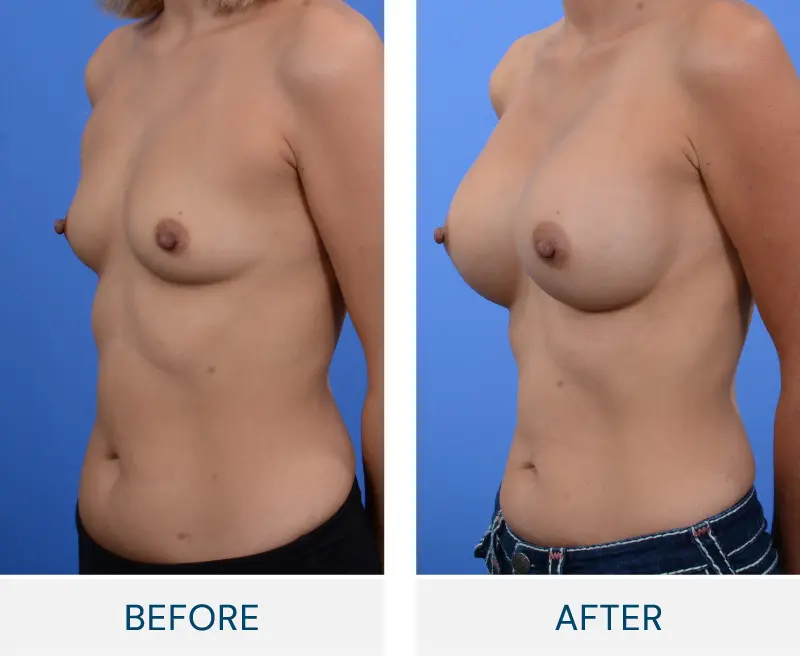 Before and After Bilateral Breast Augmentation Macleod Trail Plastic Surgery
