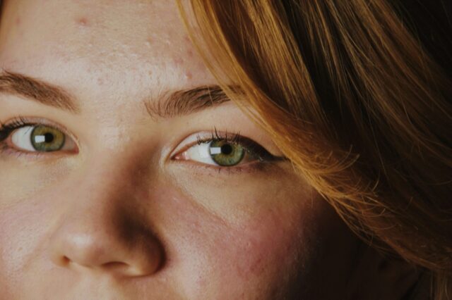 young woman with acne laser acne treatment Macleod Trail Plastic Surgery Calgary